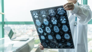 Parker Law Firm Injury Lawyers | Bedford Brain Injury Lawyer What Are the Long-Term Consequences of Brain Damage?