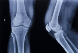 Parker Law Firm Injury Lawyers | Bedford Pedestrian Accident Lawyer What Types of Damages Can I Recover If I File a Pedestrian Accident Lawsuit in Bedford, TX?