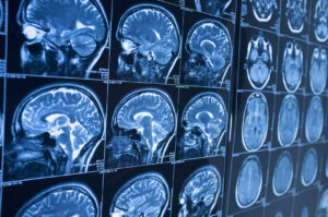 Parker Law Firm Injury Lawyers | Fort Worth Brain Injury Lawyer Brain Injury Overview